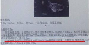 卵巢癌筛查很重要,对brca基因(直接与遗传性乳腺癌有关的基因)突变者