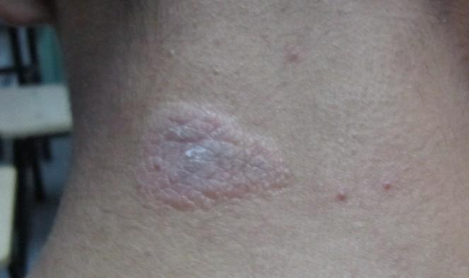 像鳞片的东西 不痛不痒 跟皮肤颜色一样 自己查过了 怀疑是日光性皮炎