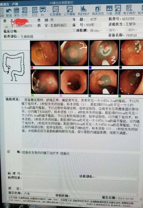 其它 一例结肠息肉的esd治疗 写美篇 思考 :结肠iia型病变,行普通内镜