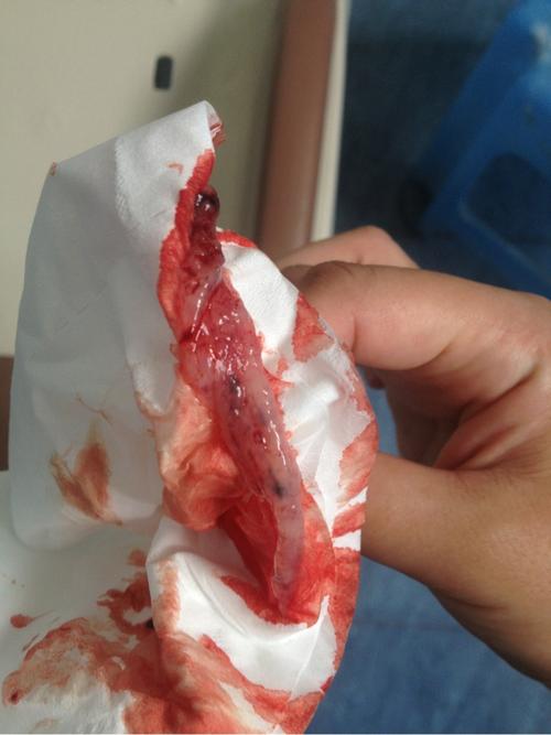 药流了,不知这是不是孕囊,有图,介意者慎入