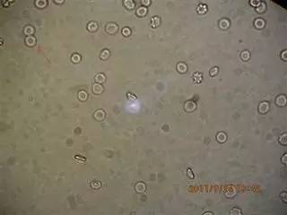 屎记:大便化验单怎么看?