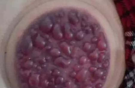 拔罐的水泡怎么办 教你怎么预防拔罐起水泡