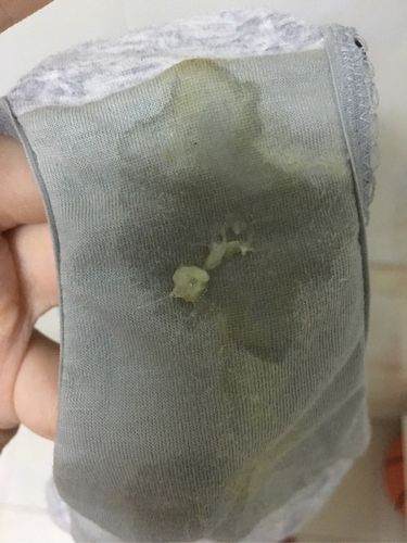 请问这样的白带是正常的吗会不会有问题