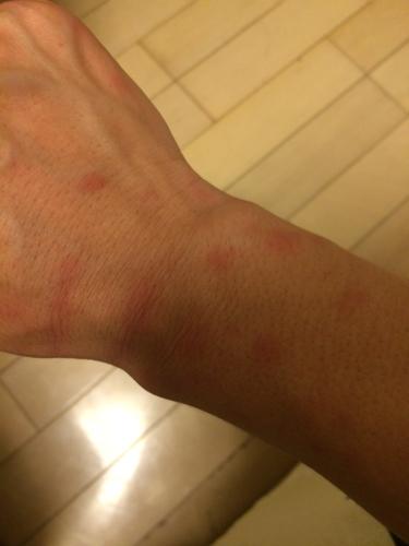 问:我一喝酒就脸红,稍微喝多,手臂出现点点红,大喝多全身出现点点红