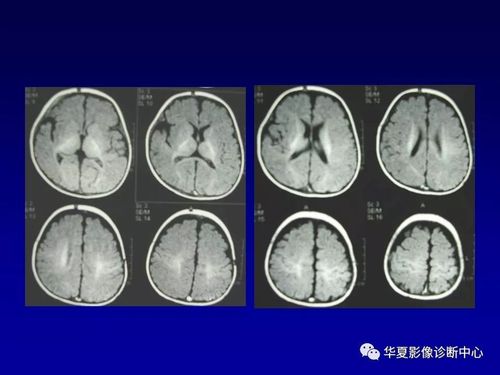 新生儿脑室周围白质软化的影像学特点