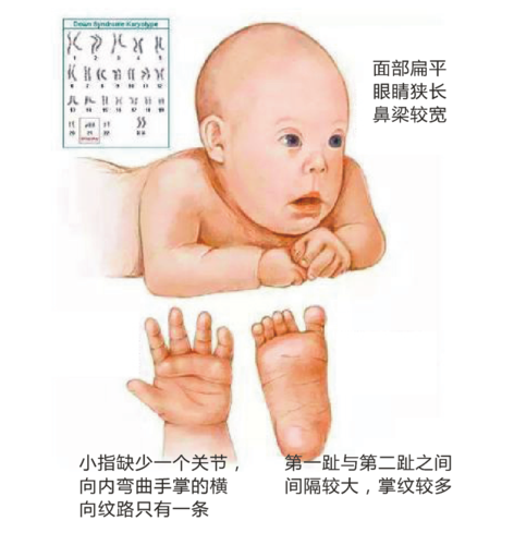 哪类人群易生出"唐氏儿"?