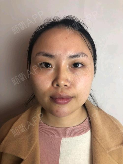 不过通过玻尿酸微调下巴之后,现在效果其实很明显啦