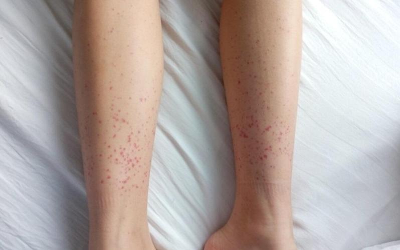 身上莫名其妙的出红点要小心血小板减少性紫癜