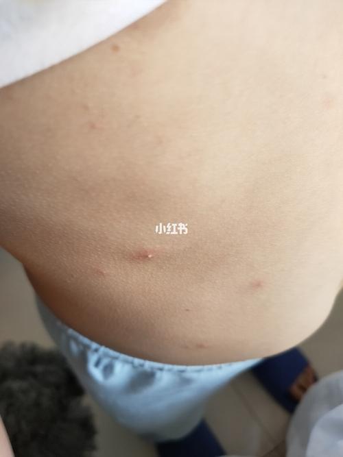 5岁孩子身上突然长这种疙瘩_热水温泉社区攻略_温泉_过敏体质_浴盐_泡