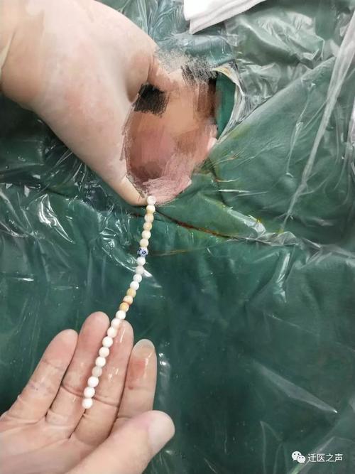 【大千世界】"珍珠项链"引发的"男"言之痛_膀胱