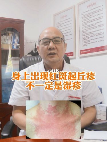 身上起红斑丘疹,不一定是湿疹_湿疹_丘疹_皮炎_皮炎湿疹_医疗健康