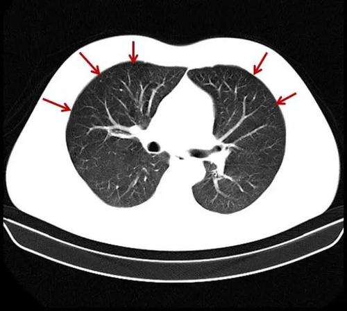 轻度肺气肿ct影像