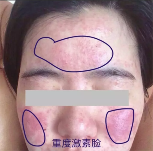 什么是激素脸?激素脸的症状