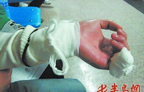 剁一截小拇指 笑称不后悔(图)      手术过后,侯清受伤的手腕和手指缠