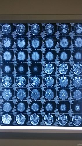 脑白质脱髓鞘改变