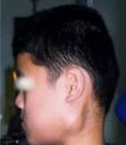 耳朵前边起了疙瘩,一检查竟是癌症!