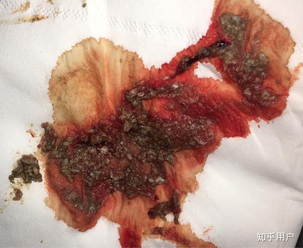 请问皮脂腺囊肿可以拖多久在屁股尖上直径一厘米左右两年前就发现了