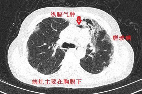 极易漏诊的间质性肺炎,从ct上怎么看?