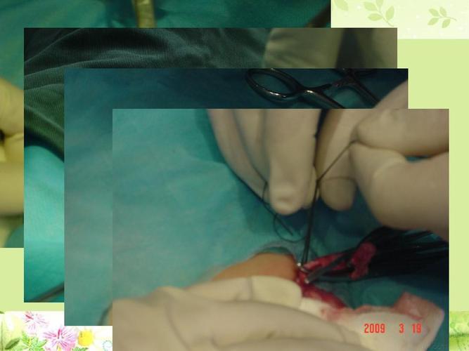 郑州微型腹腔镜下小儿疝囊高位结扎术ppt