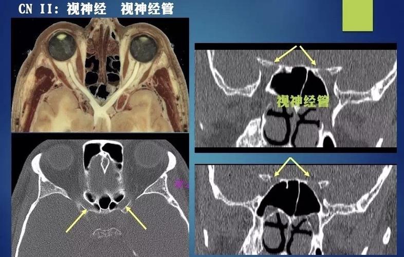 可以呈现出鼻侧视神经,颞侧视神经,视交叉,视束,视放射;d,对应的解剖