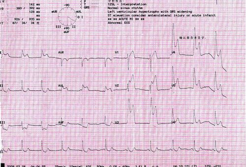 变异性心绞痛的心电图是怎样的