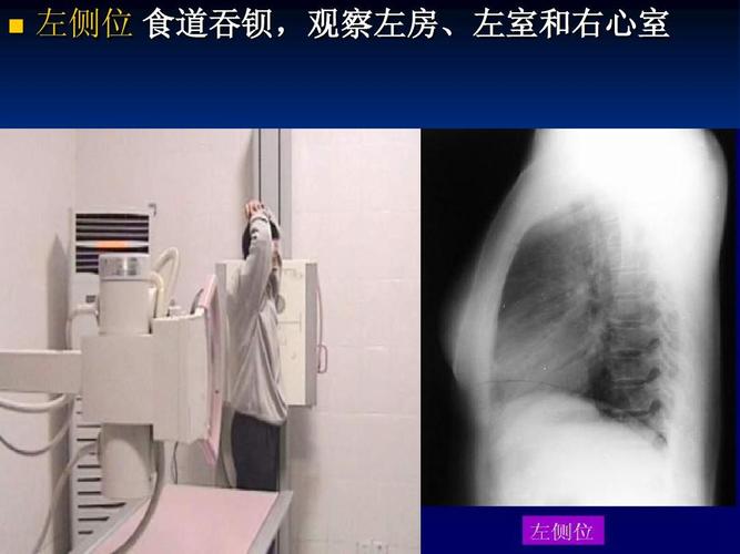 左侧位 食道吞钡,观察左房,左室和右心室