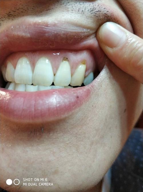 我的牙齿怎么了?请问是牙龈腐烂了吗?能治疗吗?