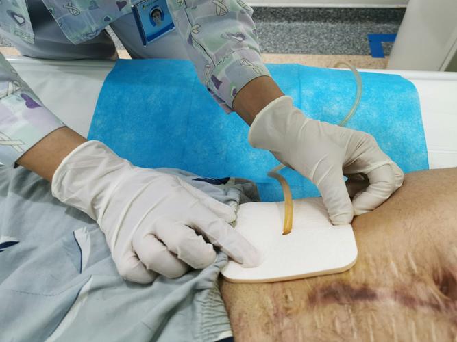 膀胱造瘘术后的护理及注意事项