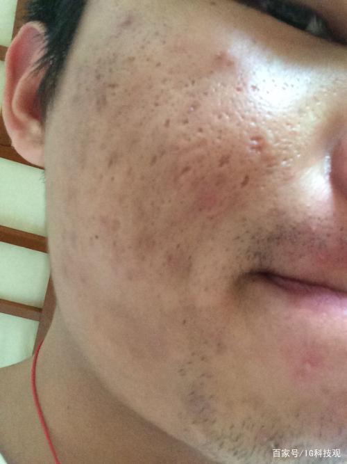 男生脸上坑坑洼洼怎么办?