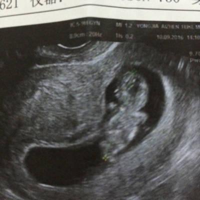 育儿问答 怀孕期 孕囊是60*29*71mm是男孩还是女孩