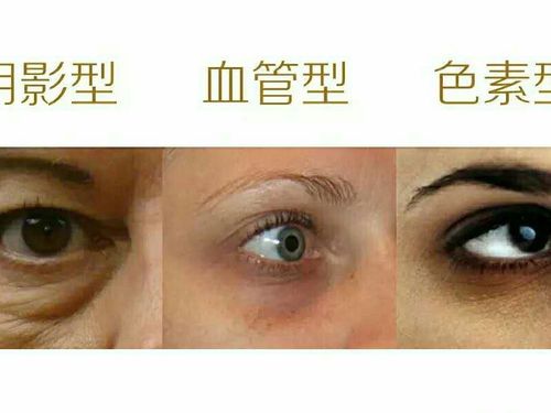 珠酱的护肤功课1:黑眼圈的3种类型,缺氧导致血管型