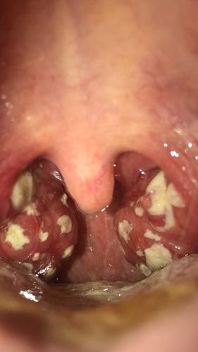 急性化脓性扁桃体炎的疼痛级别?