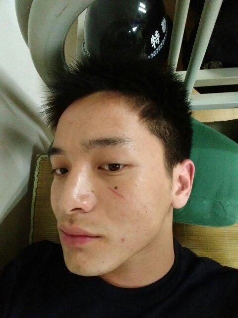 脸上的伤疤还能回到以前一样的吗,半个多月了没注意还是照常用洗面奶