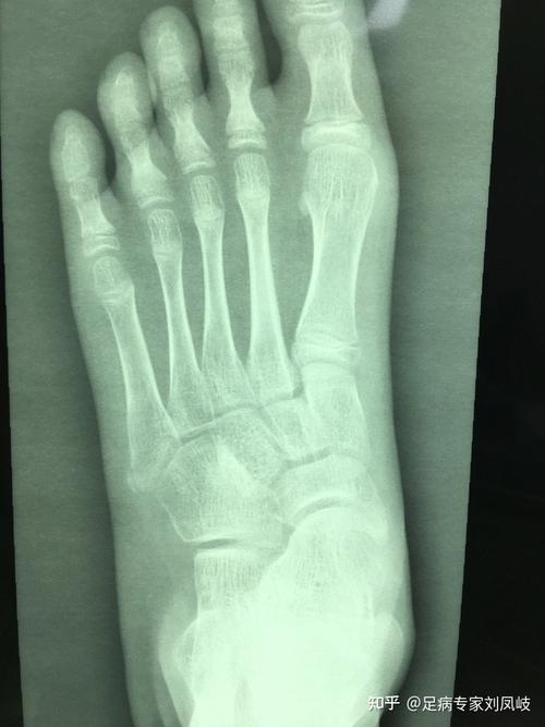 儿童脚疼的常见原因却被经常漏诊的问题北京和平里中西医结合医院骨科