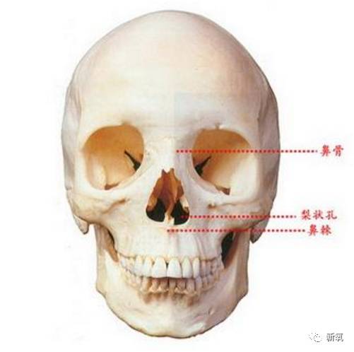 下图这个就是典型的binder综合征中的鼻畸形,和鼻旁畸形.