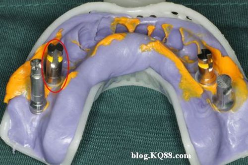 韩国osstem(奥齿泰)系统