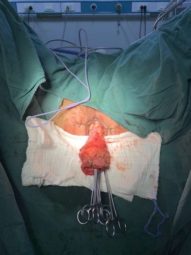 康利医院直肠脱垂手术