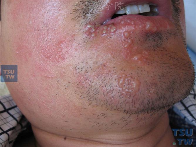 带状疱疹(herpes zoster)症状表现