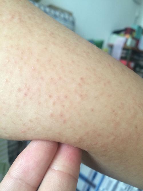 手臂上的毛孔长的像鸡皮疙瘩样的!该怎么办!