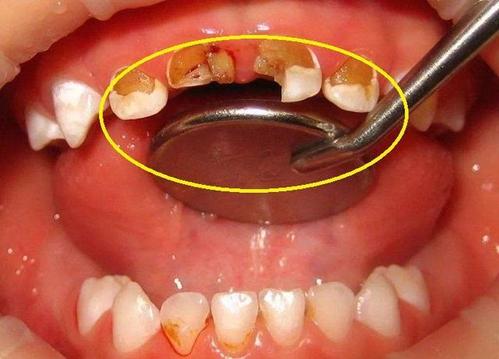 孩子长蛀牙,不仅是因为吃甜食造成,医生:这3个方面也