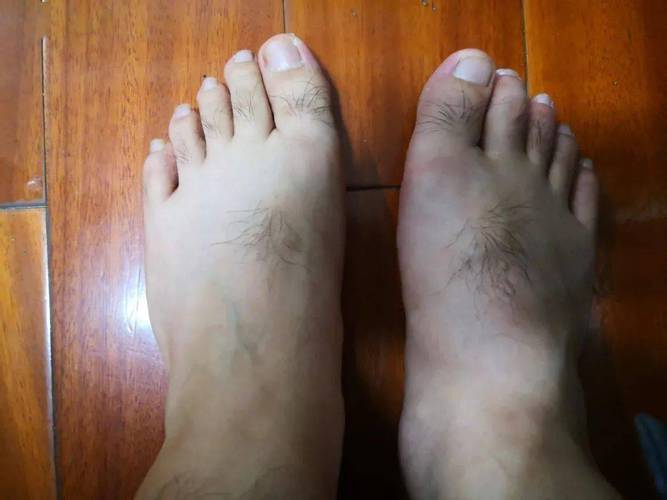 3口澳龙下肚,30岁杭州男子脚肿成"猪蹄",痛得走不动路