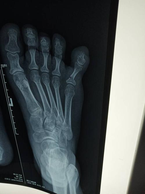 小脚拇指骨折了,没吃药,没打石膏,就用胶布和其他脚趾头固定在一起了!