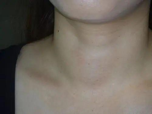 颈部淋巴结肿大不可小觑成都民生耳鼻喉医院