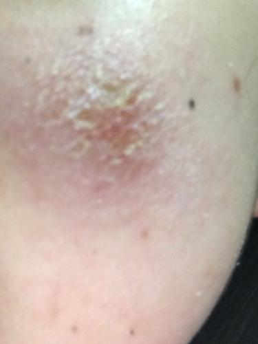 女儿左脸上长了一块癣大概有一个月了一