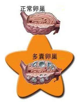 多囊卵巢一定就是多囊卵巢综合征吗?