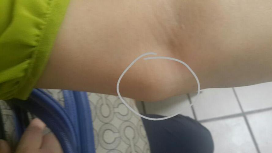 还有胳膊肘内测,也有类