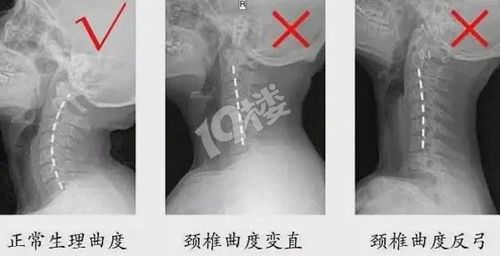 颈椎是怎么变形的