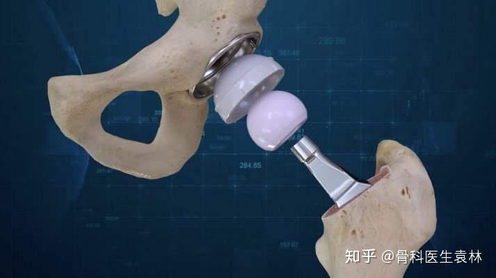 人工髋关节什么样子的?人工髋关节的使用寿命有多长?