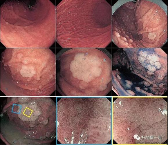 直径一般 1 cm,息肉多数是宽基底,>2 cm的息肉通常有蒂