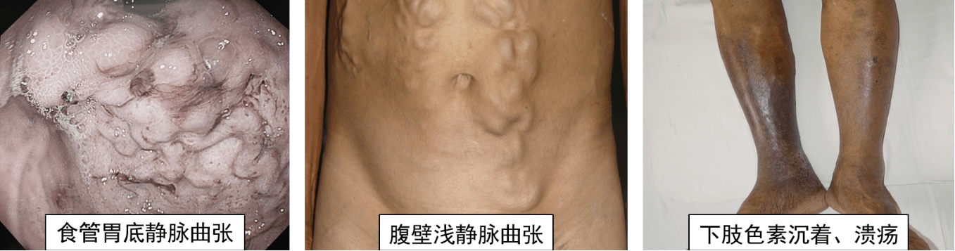 肝静脉阻塞表现:瘀血性肝肿大,脾大,腹水,腹壁静脉及食道胃底静脉曲张